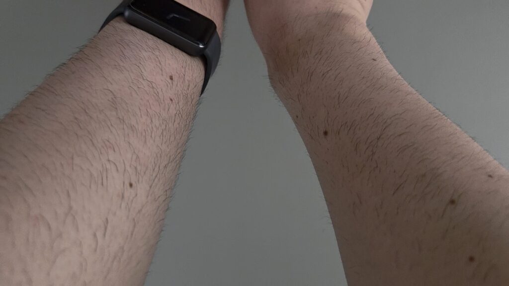 tria-laser-tria4x-6-weeks-later
