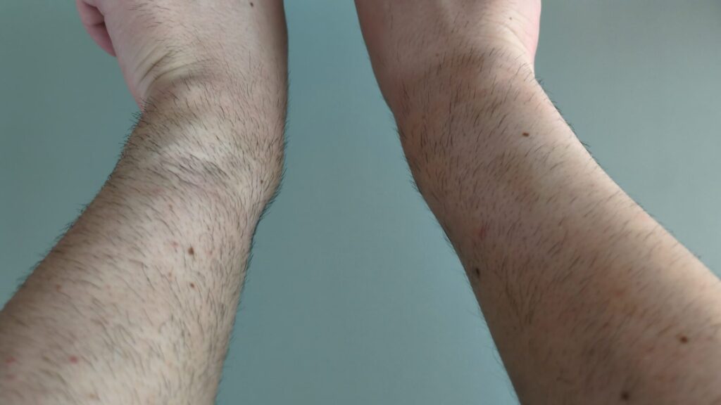 tria-laser-tria4x-8-weeks-later