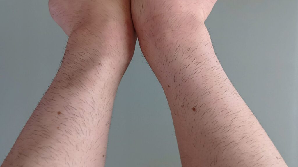 tria-laser-tria4x-4-weeks-later